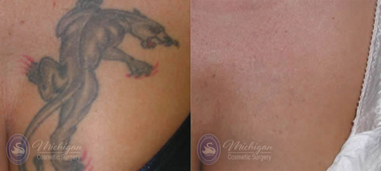 Laser Tattoo Removal Before and After Photo by Dr. Awada in Southfield Michigan