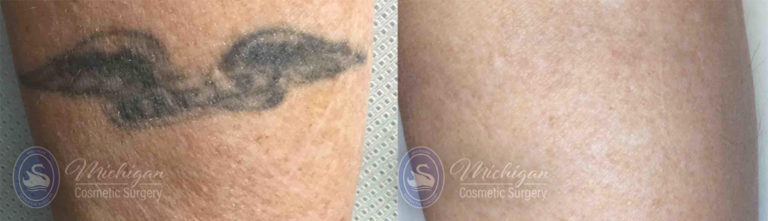 Laser Tattoo Removal Before and After Photo by Dr. Awada in Southfield Michigan