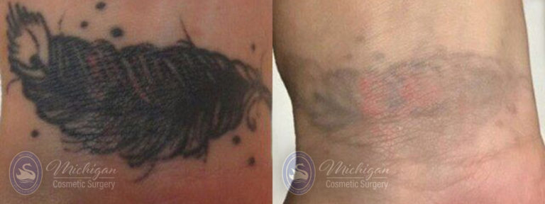 Laser Tattoo Removal Before and After Photo by Dr. Awada in Southfield Michigan