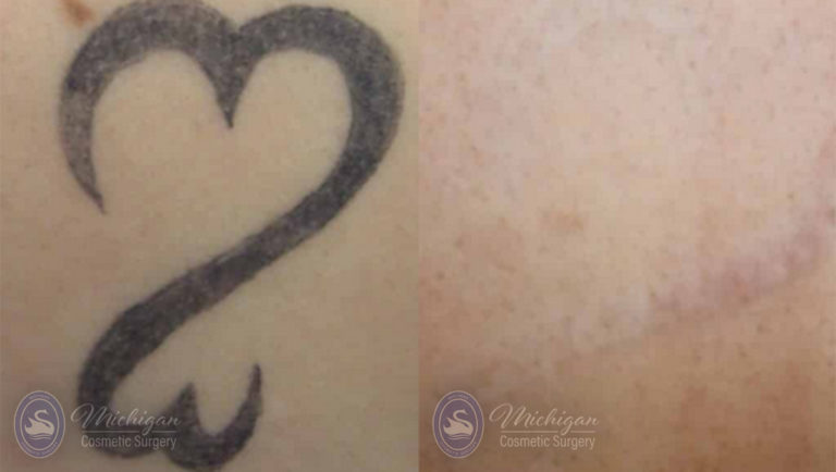 Laser Tattoo Removal Before and After Photo by Dr. Awada in Southfield Michigan