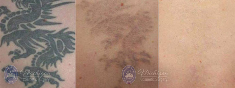 Laser Tattoo Removal Before and After Photo by Dr. Awada in Southfield Michigan