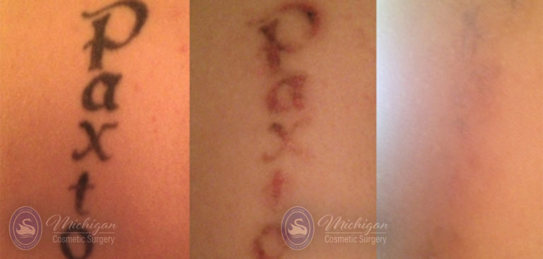 Laser Tattoo Removal Before and After Photo by Dr. Awada in Southfield Michigan