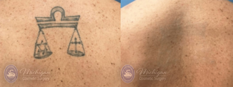 Laser Tattoo Removal Before and After Photo by Dr. Awada in Southfield Michigan
