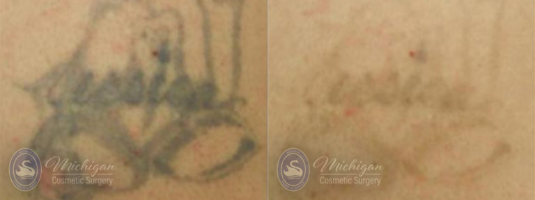 Laser Tattoo Removal Before and After Photo by Dr. Awada in Southfield Michigan