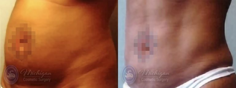 Liposuction Before and After Photo by Dr. Awada in Southfield Michigan