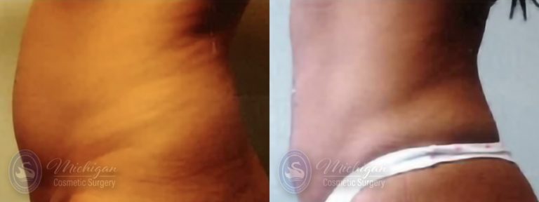 Liposuction Before and After Photo by Dr. Awada in Southfield Michigan