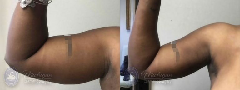 Liposuction Before and After Photo by Dr. Awada in Southfield Michigan