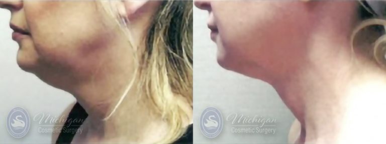 Liposuction Before and After Photo by Dr. Awada in Southfield Michigan