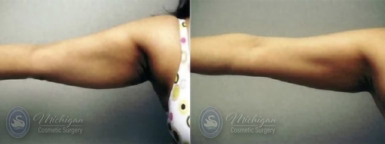 Liposuction Before and After Photo by Dr. Awada in Southfield Michigan
