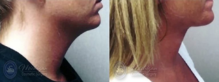 Liposuction Before and After Photo by Dr. Awada in Southfield Michigan