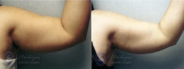 Liposuction Before and After Photo by Dr. Awada in Southfield Michigan