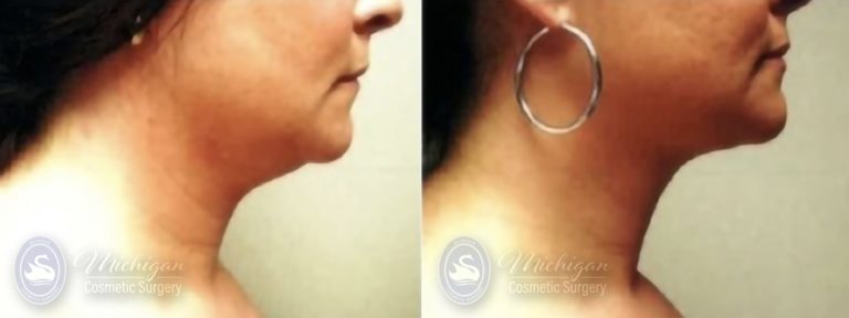 Liposuction Before and After Photo by Dr. Awada in Southfield Michigan