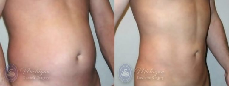 Liposuction Before and After Photo by Dr. Awada in Southfield Michigan
