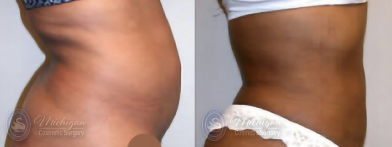 Liposuction Before and After Photo by Dr. Awada in Southfield Michigan