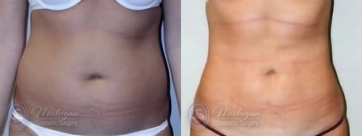 Liposuction Before and After Photo by Dr. Awada in Southfield Michigan