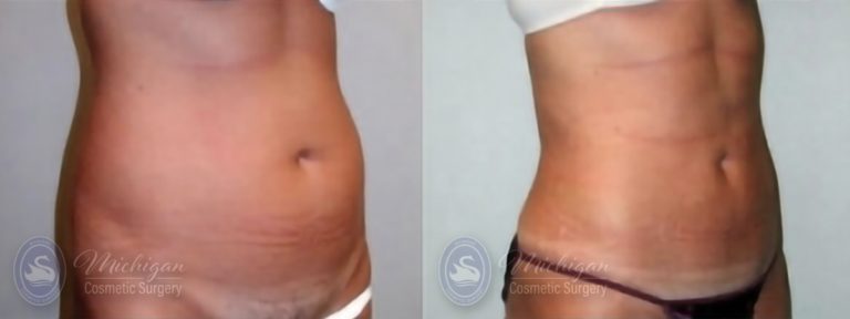 Liposuction Before and After Photo by Dr. Awada in Southfield Michigan