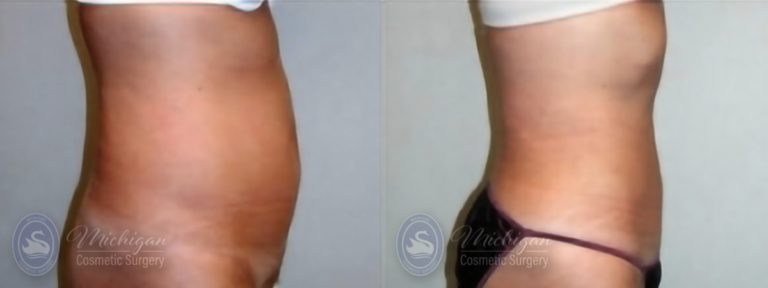 Liposuction Before and After Photo by Dr. Awada in Southfield Michigan