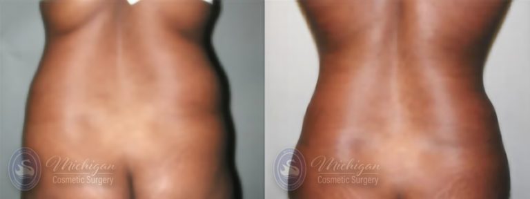 Liposuction Before and After Photo by Dr. Awada in Southfield Michigan