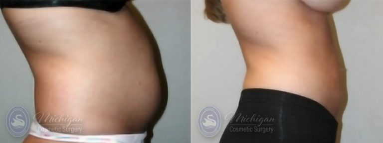Liposuction Before and After Photo by Dr. Awada in Southfield Michigan