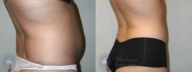 Liposuction Before and After Photo by Dr. Awada in Southfield Michigan