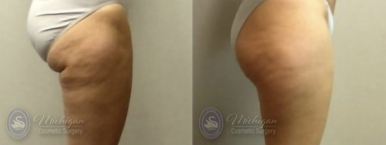 Liposuction Before and After Photo by Dr. Awada in Southfield Michigan