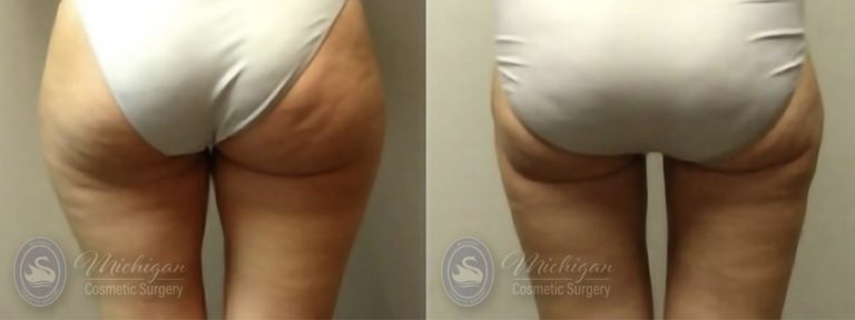 Liposuction Before and After Photo by Dr. Awada in Southfield Michigan