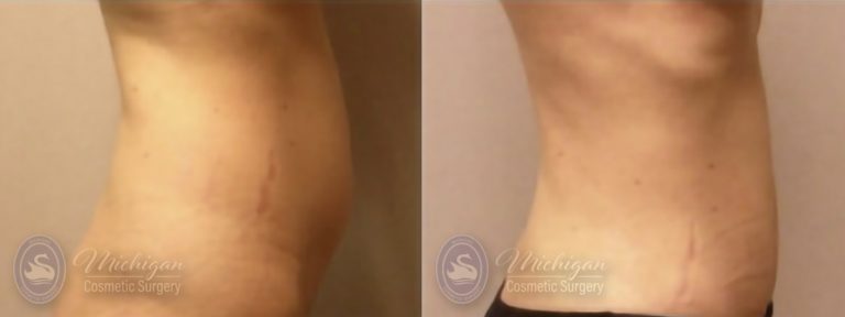 Liposuction Before and After Photo by Dr. Awada in Southfield Michigan