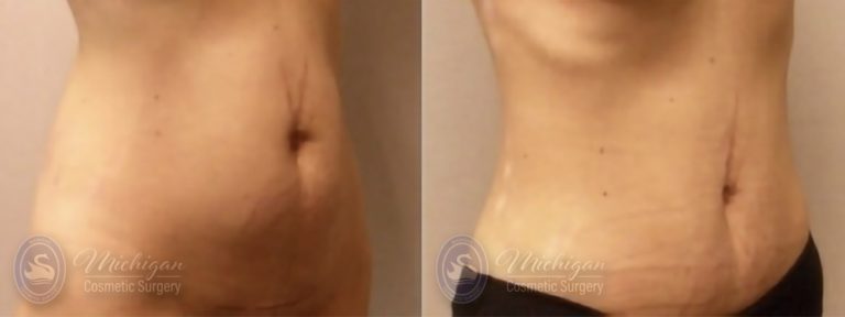 Liposuction Before and After Photo by Dr. Awada in Southfield Michigan