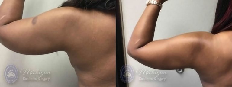 Liposuction Before and After Photo by Dr. Awada in Southfield Michigan