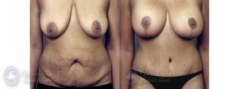 Mommy Makeover Before and After Photo by Dr. Awada in Southfield Michigan