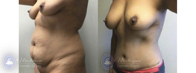 Mommy Makeover Before and After Photo by Dr. Awada in Southfield Michigan