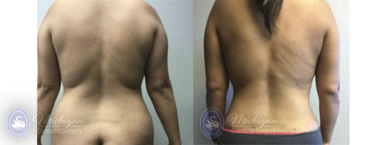 Mommy Makeover Before and After Photo by Dr. Awada in Southfield Michigan