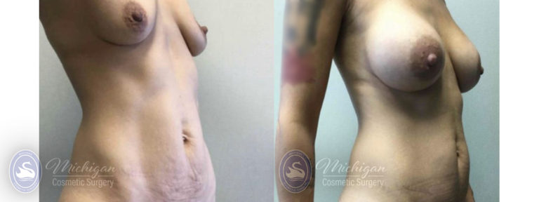 Mommy Makeover Before and After Photo by Dr. Awada in Southfield Michigan