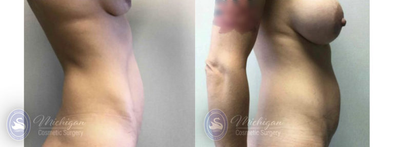 Mommy Makeover Before and After Photo by Dr. Awada in Southfield Michigan
