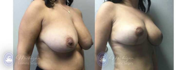 Mommy Makeover Before and After Photo by Dr. Awada in Southfield Michigan