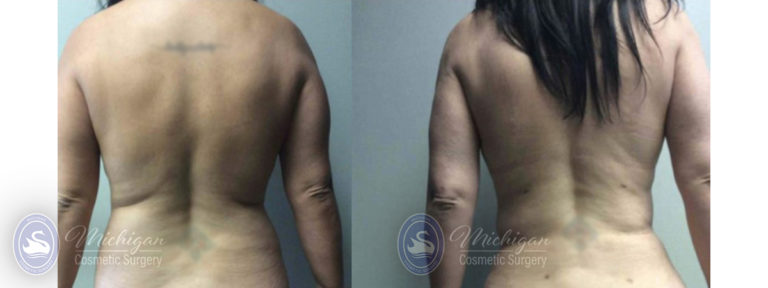 Mommy Makeover Before and After Photo by Dr. Awada in Southfield Michigan