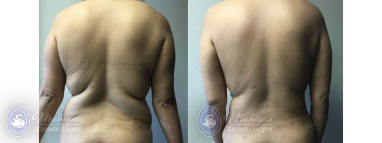 Mommy Makeover Before and After Photo by Dr. Awada in Southfield Michigan