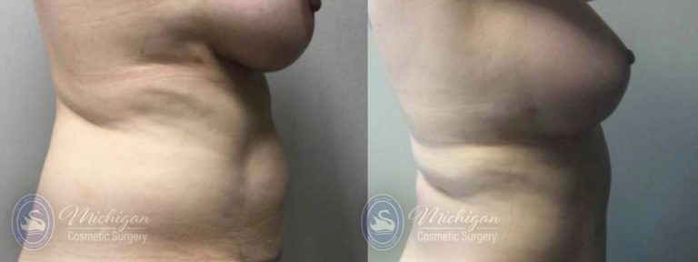Mommy Makeover Before and After Photo by Dr. Awada in Southfield Michigan