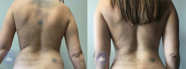 Mommy Makeover Before and After Photo by Dr. Awada in Southfield Michigan