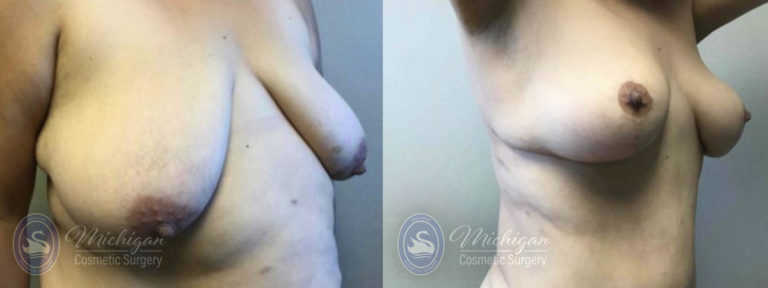 Mommy Makeover Before and After Photo by Dr. Awada in Southfield Michigan
