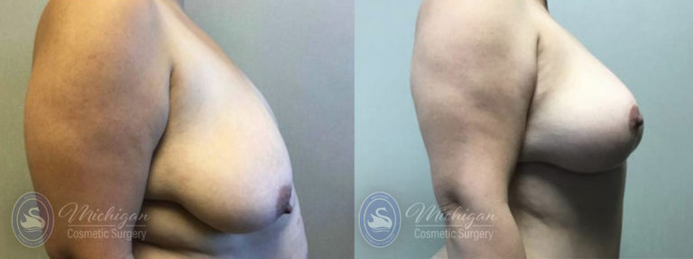 Mommy Makeover Before and After Photo by Dr. Awada in Southfield Michigan