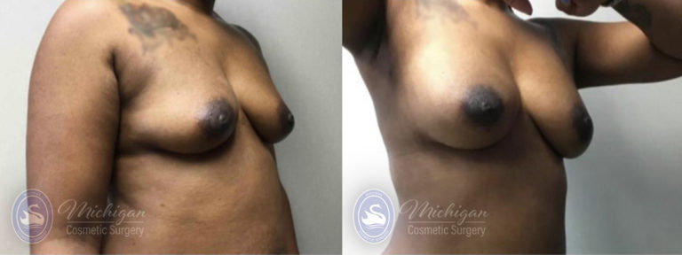 Mommy Makeover Before and After Photo by Dr. Awada in Southfield Michigan