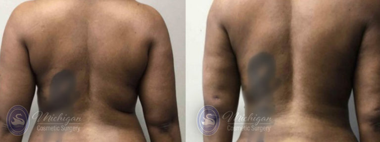 Mommy Makeover Before and After Photo by Dr. Awada in Southfield Michigan
