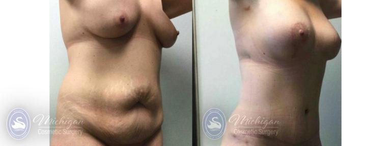 Mommy Makeover Before and After Photo by Dr. Awada in Southfield Michigan