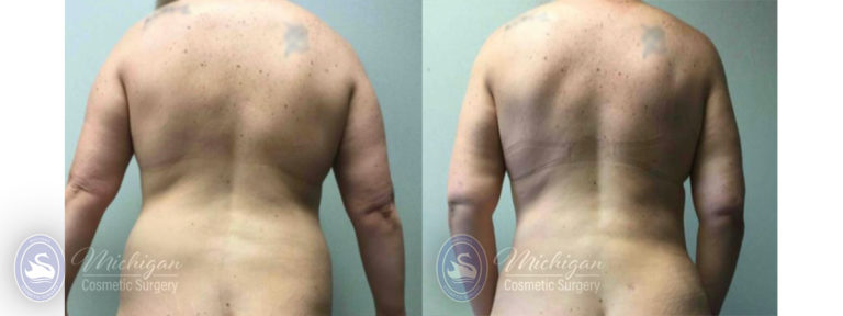 Mommy Makeover Before and After Photo by Dr. Awada in Southfield Michigan