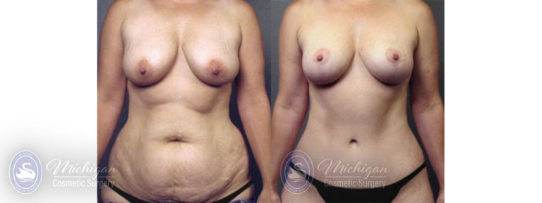 Mommy Makeover Before and After Photo by Dr. Awada in Southfield Michigan