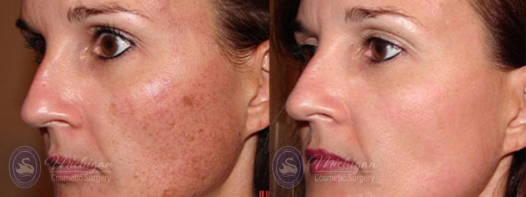 Pigment & Redness Before and After Photo by Dr. Awada in Southfield Michigan