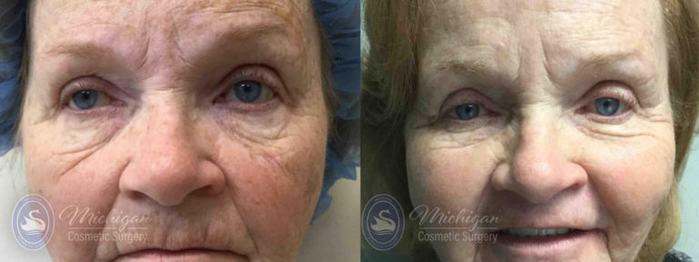 Pigment & Redness Before and After Photo by Dr. Awada in Southfield Michigan
