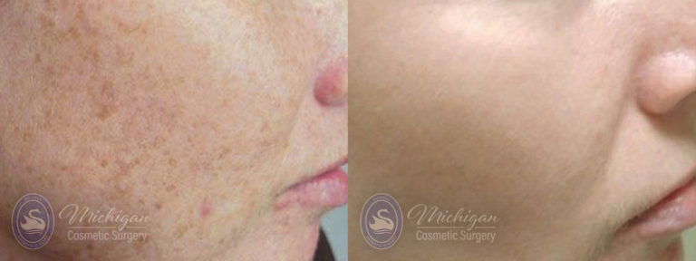 Pigment & Redness Before and After Photo by Dr. Awada in Southfield Michigan
