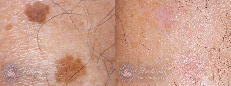Pigment & Redness Before and After Photo by Dr. Awada in Southfield Michigan